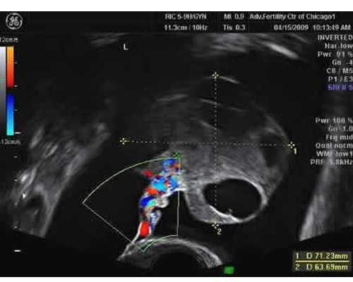四川供卵三代试管婴儿多少钱,四川哪些能做三代供卵选性别？附供卵包生男孩